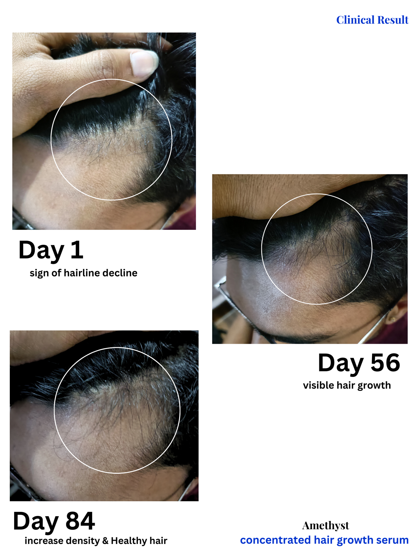 before and after image of men residing hair line to thicker healthy hair grow amethyst hair growth serum