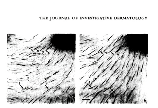 Hair growth using Procapil & Redesyl